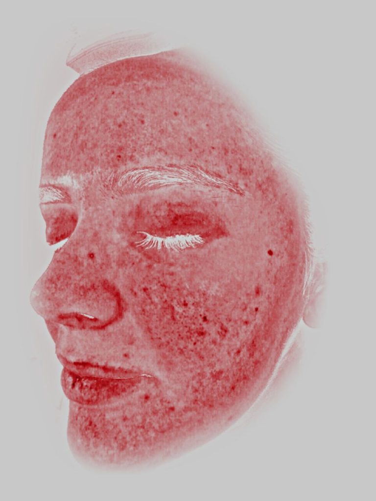 3_Cara izquierda-Gráfico de eritropoyetina sensible (1)