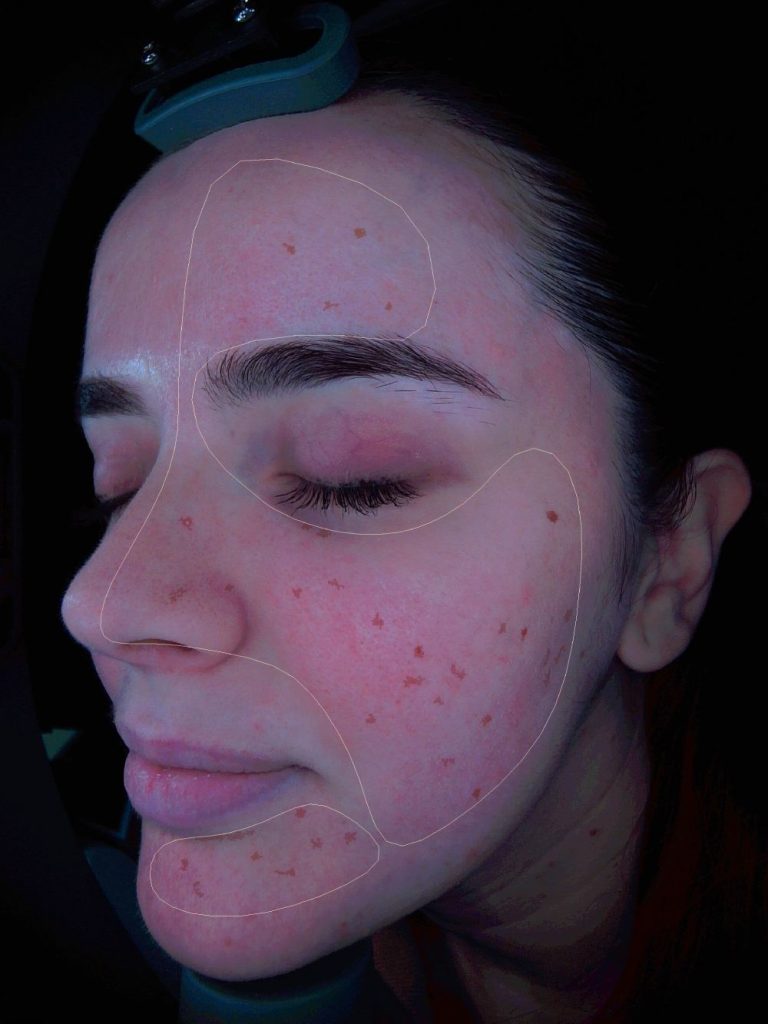 48_Cara izquierda-Mancha mixta (1)