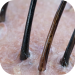Grosor del cabello: análisis del cuero cabelludo con dermoanalizador