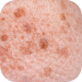 Manchas solares: análisis de la piel con dermoanalizador